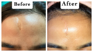 Scar Revision Surgery Laser Treatment for Scar