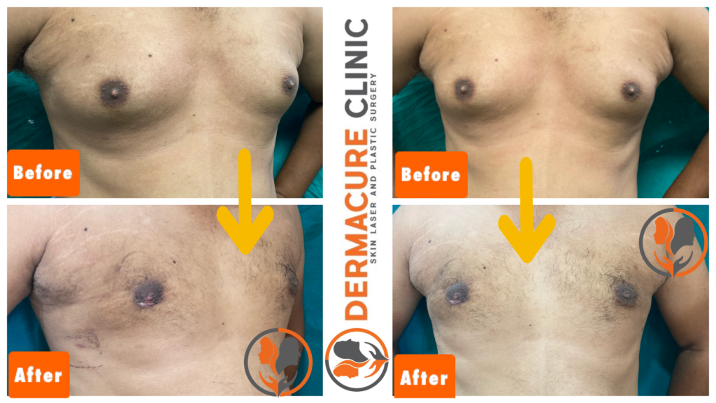 Puffy Nipples Gynecomastia Stages